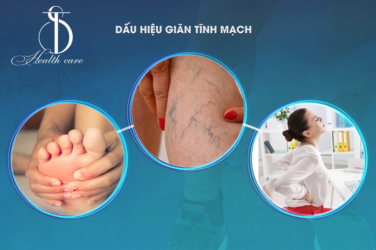 NHẬN BIẾT DẤU HIỆU GIÃN TĨNH MẠCH - NGUYÊN NHÂN VÀ CÁCH ĐIỀU TRỊ