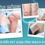 ÍT VẬN ĐỘNG CÓ DỄ DẪN ĐẾN BỆNH SUY GIÃN TĨNH MẠCH KHÔNG?