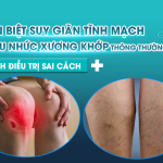 PHÂN BIỆT SUY GIÃN TĨNH MẠCH VÀ ĐAU NHỨC XƯƠNG KHỚP THÔNG THƯỜNG TRÁNH ĐIỀU TRỊ SAI CÁCH
