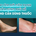 CÁCH LÀM MỜ GÂN XANH VÀ GIẢM SƯNG PHÙ NỀ KHÔNG CẦN DÙNG THUỐC