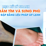 MẸO XỬ LÝ NHANH VẾT BẦM TÍM VÀ SƯNG PHÙ DO VA ĐẬP BẰNG LIỆU PHÁP ÁP LẠNH
