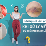 NHỮNG SAI LẦM PHỔ BIẾN KHI XỬ LÝ VẾT BẦM – CÓ THỂ BẠN ĐANG LẦM TƯỞNG