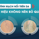 Vết tĩnh mạch nổi trên da – Dấu hiệu không nên bỏ qua