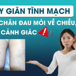 Suy giãn tĩnh mạch – Khi chân đau mỏi về chiều, hãy cảnh giác