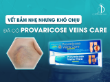 Vết bầm nhẹ nhưng gây khó chịu - nay đã có Provaricose Veins Care
