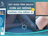 SUY GIÃN TĨNH MẠCH - CƠN ÁC MỘNG KHÔNG CỦA RIÊNG AI