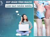Suy giãn tĩnh mạch - Làm sao ngăn ngừa sớm