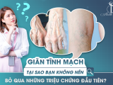 Giãn Tĩnh Mạch: Tại Sao Bạn Không Nên Bỏ Qua Những Triệu Chứng Đầu Tiên?