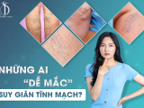 NHỮNG AI DỄ MẮC SUY GIÃN TĨNH MẠCH?