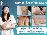 Suy giãn tĩnh mạch - Bệnh lý âm thầm nhiều người chủ quan