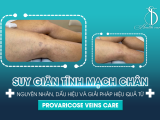 SUY GIÃN TĨNH MẠCH CHÂN: NGUYÊN NHÂN, DẤU HIỆU VÀ GIẢI PHÁP HIỆU QUẢ TỪ PROVARICOSE VEINS CARE