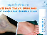MẸO XỬ LÝ NHANH VẾT BẦM TÍM VÀ SƯNG PHÙ DO VA ĐẬP BẰNG LIỆU PHÁP ÁP LẠNH