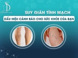 Suy Giãn Tĩnh Mạch - Dấu Hiệu Cảnh Báo Cho Sức Khỏe Của Bạn