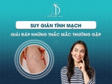 Suy Giãn Tĩnh Mạch: Giải Đáp Những Thắc Mắc Thường Gặp