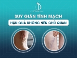 Suy Giãn Tĩnh Mạch: Hậu Quả Không Nên Chủ Quan