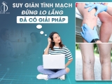 SUY GIÃN TĨNH MẠCH - ĐỪNG LO LẮNG, ĐÃ CÓ GIẢI PHÁP