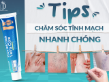 Tips chăm sóc tĩnh mạch nhanh chóng