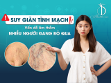 Suy giãn tĩnh mạch – Vấn đề âm thầm nhiều người đang bỏ qua