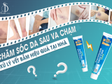 CHĂM SÓC DA SAU VA CHẠM - XỬ LÝ VẾT BẦM HIỆU QUẢ TẠI NHÀ 