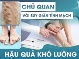 Chủ quan với suy giãn tĩnh mạch – hậu quả khó lường
