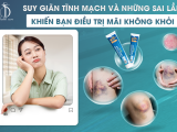 Suy giãn tĩnh mạch và những sai lầm khiến bạn điều trị mãi không khỏi