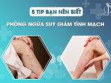 5 TIPS BẠN NÊN BIẾT - PHÒNG NGỪA SUY GIÃN TĨNH MẠCH