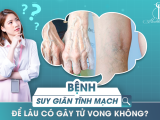 BỆNH SUY GIÃN TĨNH MẠCH ĐỂ LÂU CÓ GÂY TỬ VONG KHÔNG?