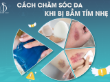 Cách chăm sóc da khi bị bầm tím nhẹ