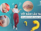 Vết bầm lâu tan: Có phải là tuần hoàn kém