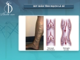 CÁC TRIỆU CHỨNG SUY GIÃN TĨNH MẠCH: BIẾT ĐỂ PHÒNG TRÁNH VÀ ĐIỀU TRỊ KỊP THỜI