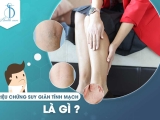 TRIỆU CHỨNG SUY GIÃN TĨNH MẠCH LÀ GÌ?