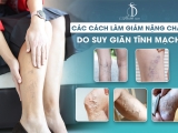 Các cách làm giảm nặng chân do suy giãn tĩnh mạch