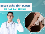 BỊ SUY GIÃN TĨNH MẠCH, KHI NÀO CẦN ĐI KHÁM? 