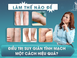 LÀM THẾ NÀO ĐỂ ĐIỀU TRỊ SUY GIÃN TĨNH MẠCH MỘT CÁCH HIỆU QUẢ?