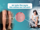 SUY GIÃN TĨNH MẠCH ẢNH HƯỞNG NHƯ THẾ NÀO?