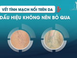 Vết tĩnh mạch nổi trên da – Dấu hiệu không nên bỏ qua