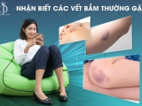 Nhận biết các vết bầm thường gặp