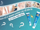 CÁCH XỬ LÝ NHANH CHÓNG CÁC VẾT BẦM TÍM TẠI NHÀ HIỆU QUẢ