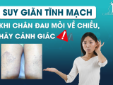 Suy giãn tĩnh mạch – Khi chân đau mỏi về chiều, hãy cảnh giác