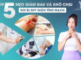 TOP 5 MẸO GIẢM ĐAU VÀ KHÓ CHỊU KHI BỊ SUY GIÃN TĨNH MẠCH