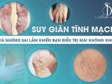 Suy giãn tĩnh mạch và những sai lầm khiến bạn điều trị mãi không khỏi - Bạn nên biết