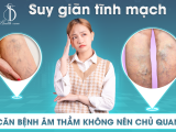 Suy giãn tĩnh mạch – Căn bệnh âm thầm không nên chủ quan