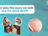 SUY GIÃN TĨNH MẠCH CHI DƯỚI: DÂN VĂN PHÒNG NÊN BIẾT