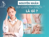 NGUYÊN NHÂN SUY GIÃN TĨNH MẠCH LÀ GÌ?