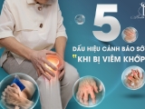 5 Dấu hiệu cảnh báo sớm khi bị viêm khớp