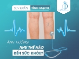 SUY GIÃN TĨNH MẠCH ẢNH HƯỞNG NHƯ THẾ NÀO ĐẾN SỨC KHỎE?