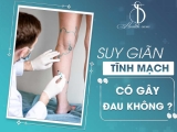 SUY GIÃN TĨNH MẠCH CÓ GÂY ĐAU KHÔNG?