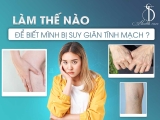 LÀM THẾ NÀO ĐỂ BIẾT MÌNH BỊ SUY GIÃN TĨNH MẠCH?