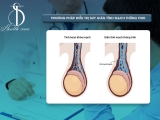 Hiểu Rõ Về Bệnh Suy Giãn Tĩnh Mạch Thừng Tinh Và Cách Điều Trị Hiệu Quả