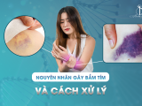 NGUYÊN NHÂN GÂY BẦM TÍM VÀ CÁCH XỬ LÝ